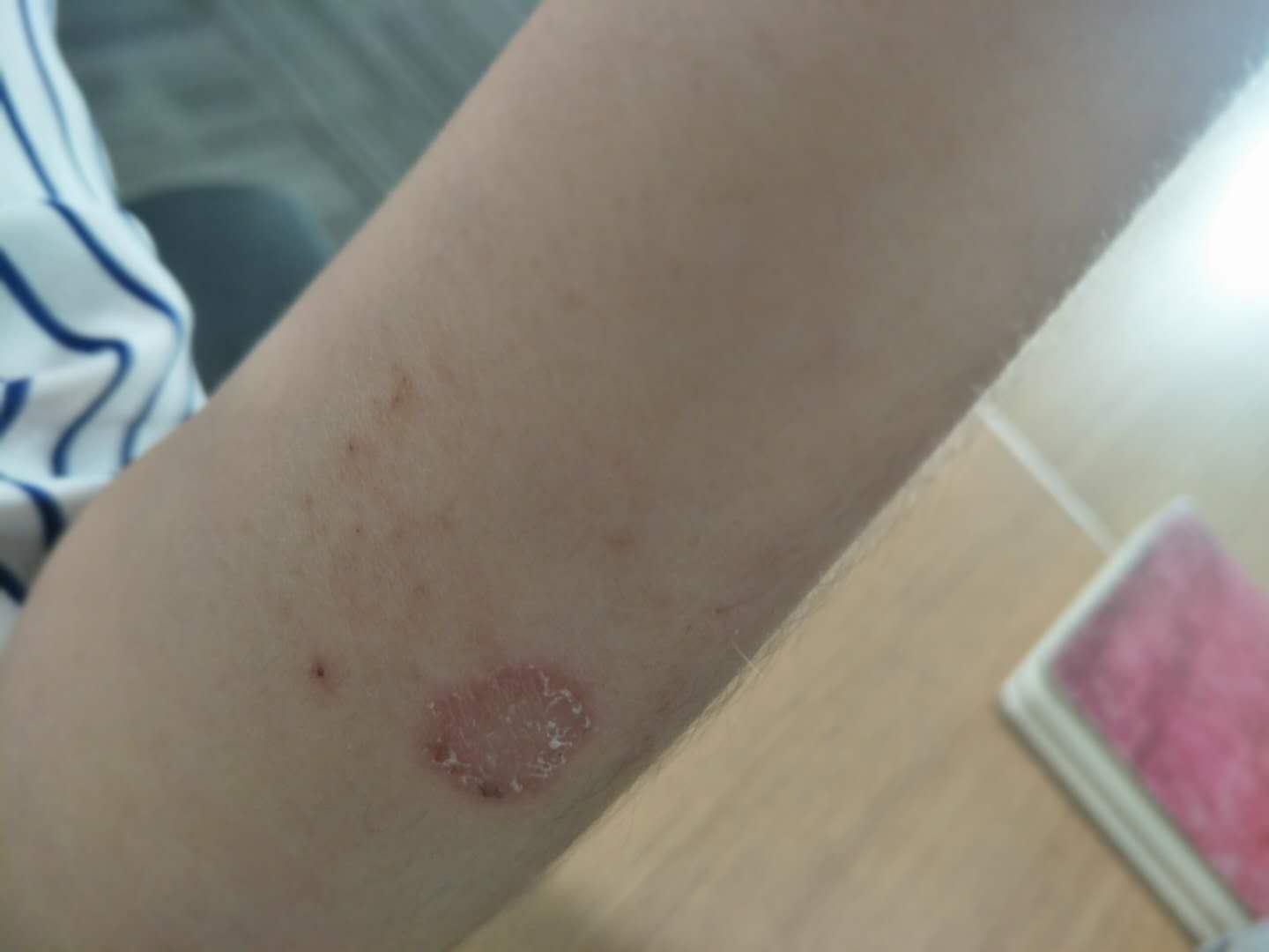 猫癣如何辨别是旧猫癣还是新猫癣,怎样判断是不是猫癣