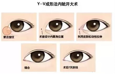 睑裂短内眦距离较宽,内眦严重但眼距窄怎么办