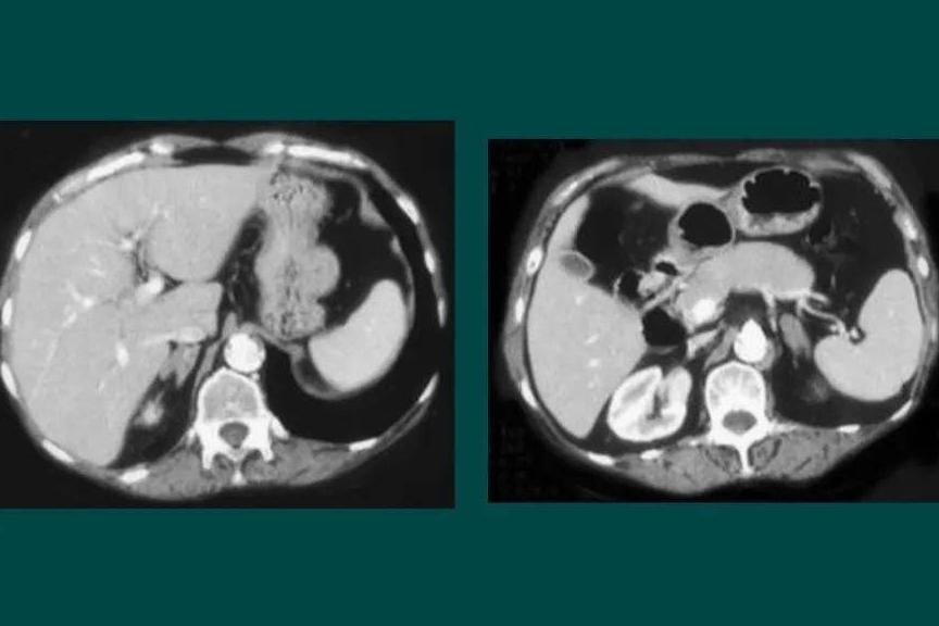 垂体瘤患者ACTH很低,ACTH缺乏症