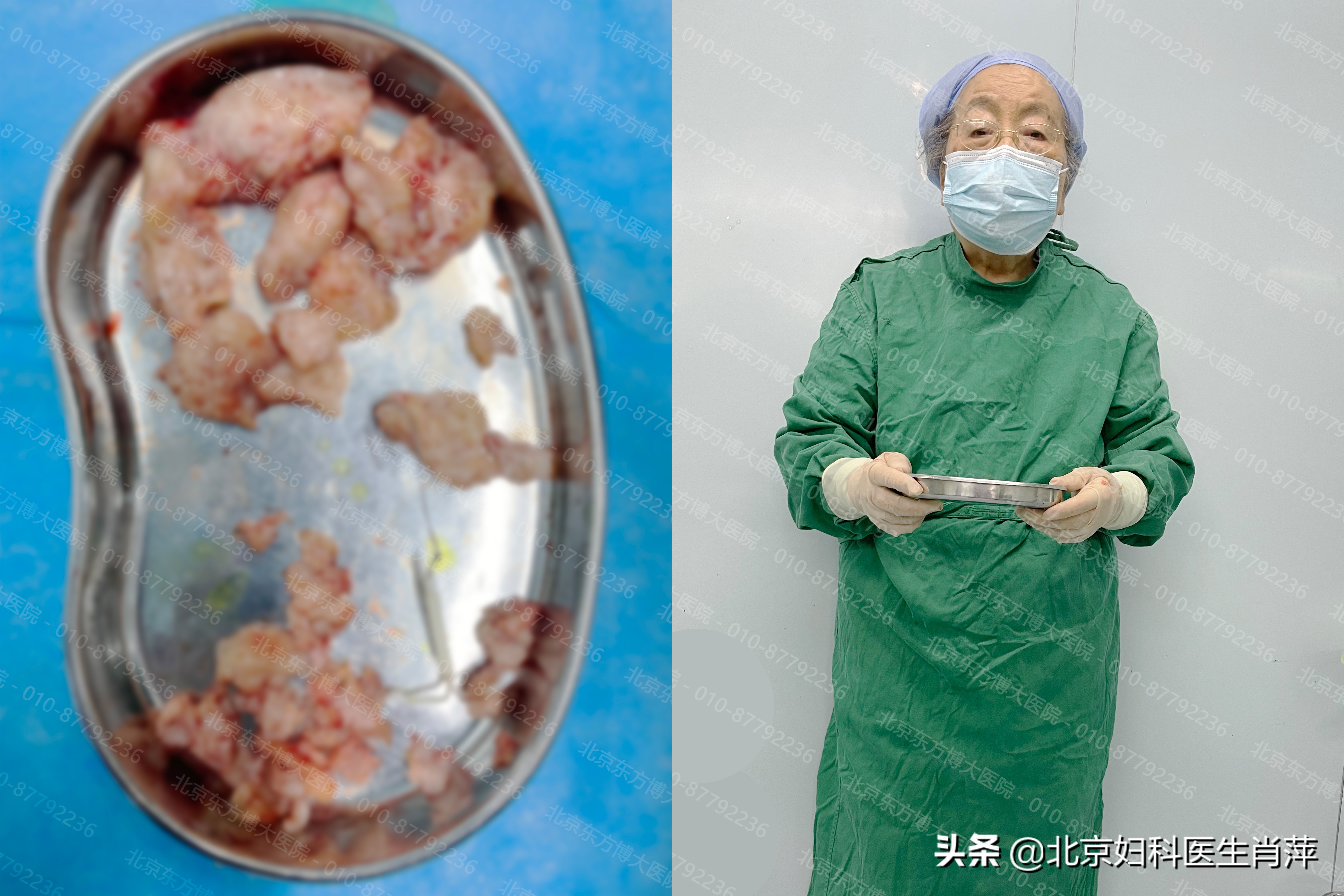 孙爱达教授治疗腺肌症怎么样,孙爱达腺肌症手术靠谱吗