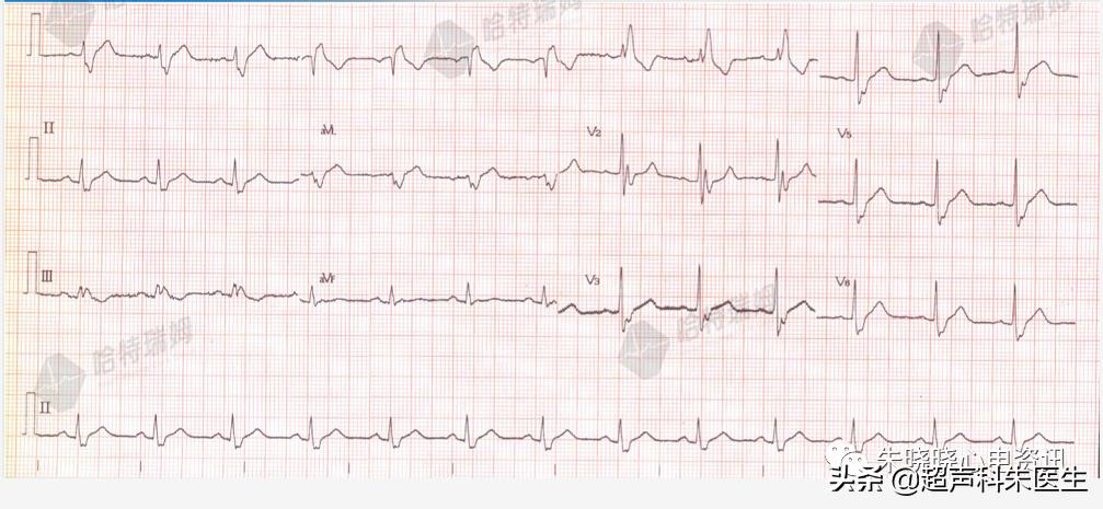 t波倒置9个真相图解,t波倒置判断口诀