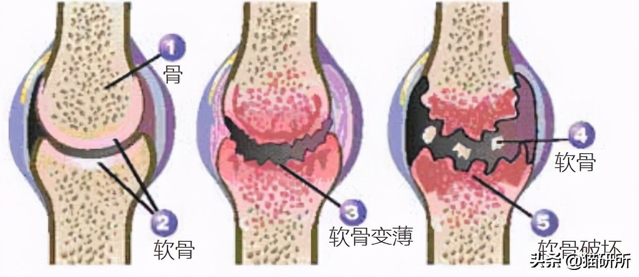 软骨素对全身疼痛有用吗,软骨素对膝关节疼痛有什么好处