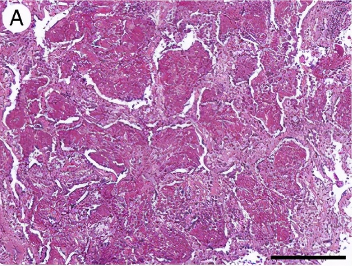 养鸽子造成皮肤真菌感染,养鸽子会得肺炎吗