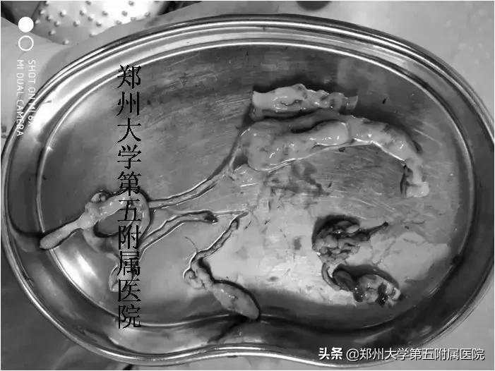 生死一脉牵，一例下腔静脉平滑肌瘤病的诊治历程