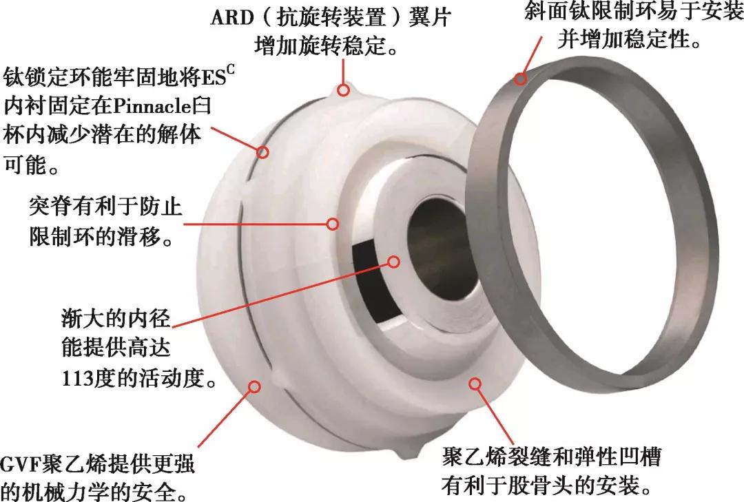 髋关节翻修术手术流程,人工髋关节翻修材料的选择