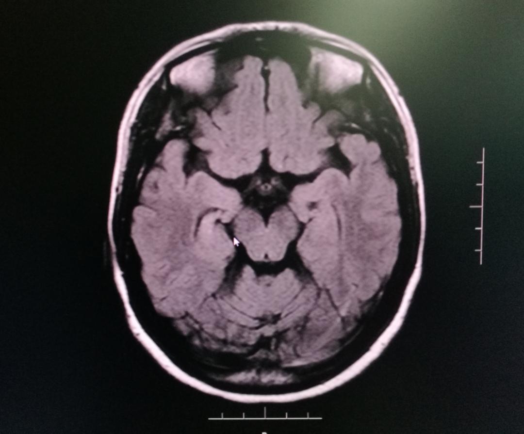 癫痫女性患者怀孕后换药影响大吗,癫痫病人怀孕可以停药不