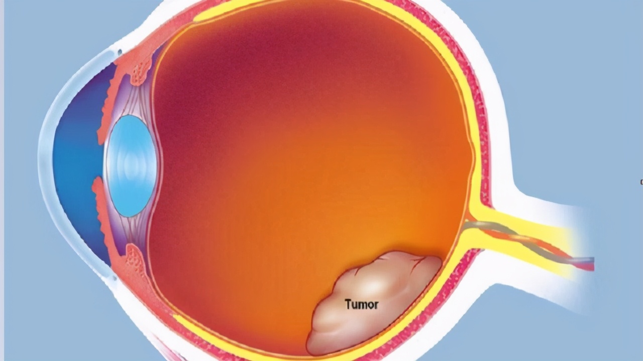 视网膜母细胞瘤是癌症吗,视网膜母细胞瘤为一种恶性肿瘤