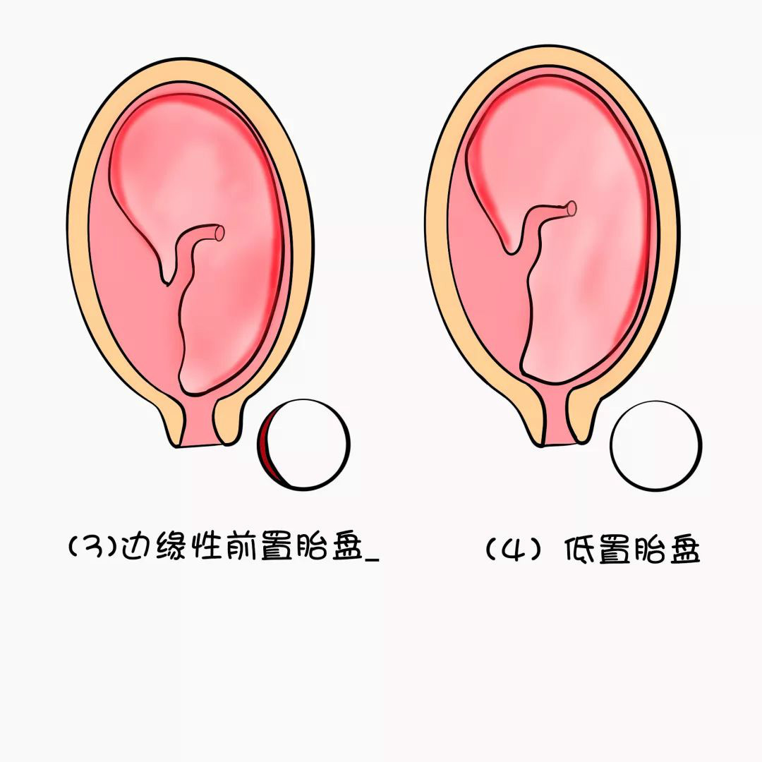 前置胎盘的护理诊断及措施,前置胎盘的护理诊断