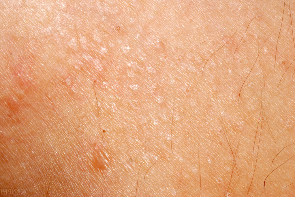 痘痘如何治疗4个皮肤科常见病例,痘痘也属于皮疹吗