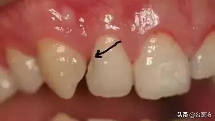 牙缝里有黑黑的怎样正确刷牙,牙缝里面有黑黑的东西是什么