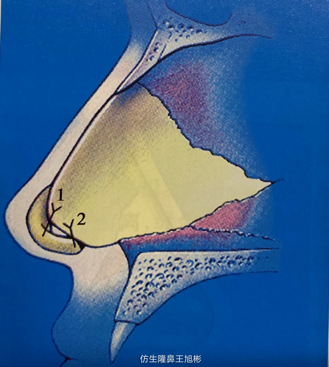 窄鼻子如何通过鼻整形来矫正,宽鼻子矫正方法