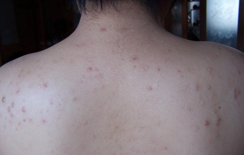 背部爆痘用什么药,背部长痘原因以及怎么调理