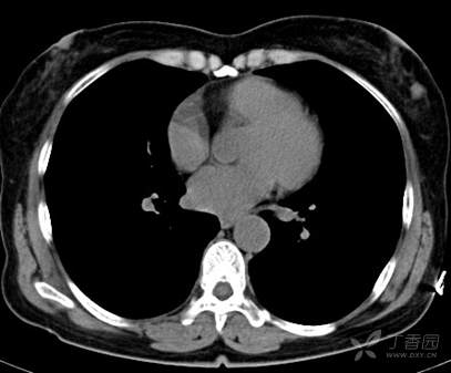乳腺结节有消散的病例吗,一份完整的乳腺增生病例