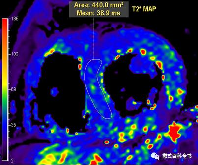 心脏磁共振定位方法,心脏磁共振各参数分析