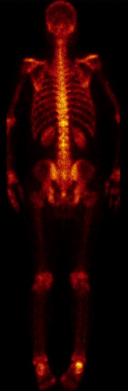 前列腺癌转移骨髓瘤治愈经验,前列腺癌骨转移抗癌成功案例