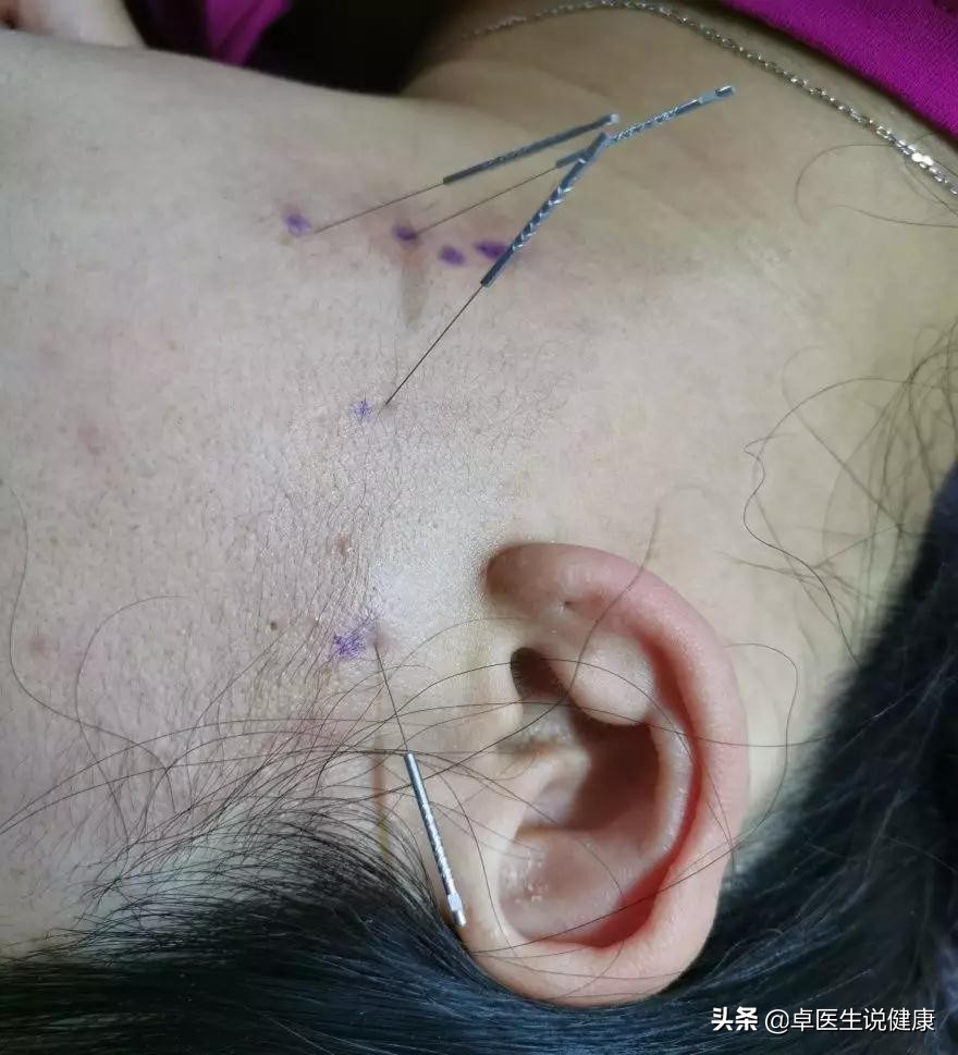 腰肌劳损针灸哪些穴位比较好,颊针疗法和针灸哪种好