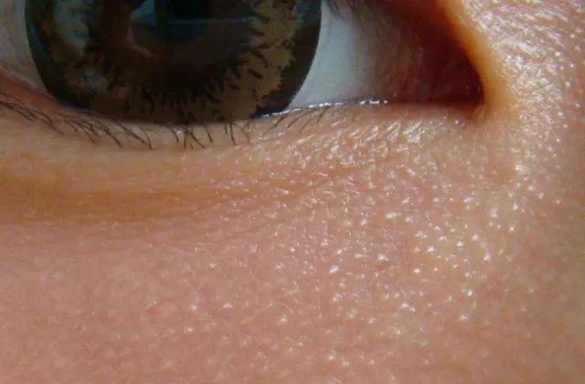 怎么会长脂肪粒啊,脸为啥会长脂肪粒