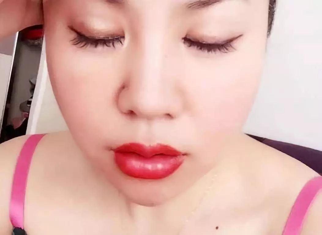 41岁考虑线雕和拉皮哪个好,线雕40岁后的感受