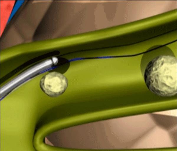 小孩胆结石可以做取石保胆手术吗,胆囊炎胆结石可以做保胆取石术吗