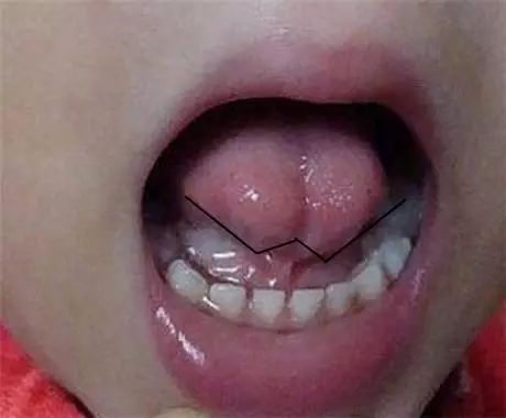 4岁舌系带过短要不要剪,什么是舌系带短图片