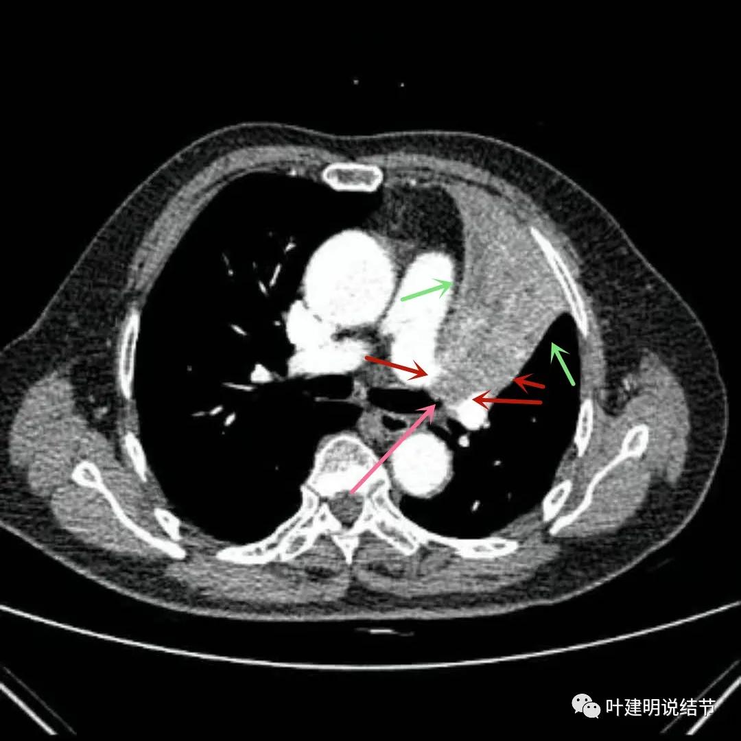 高龄肺癌靶向治疗效果,高龄老人肺癌早期适合放疗吗