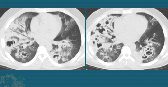 流感合并细菌感染时有什么症状,流感合并细菌感染可以治好吗