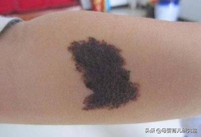 宝宝身上的青胎记能消么,宝宝身上有很多胎记淤青是为什么
