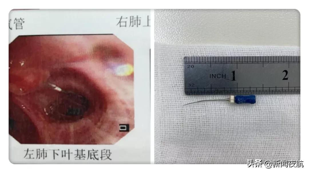 男子治牙，针却从嘴里掉进去了！做胃镜还没找到，针掉哪儿了？