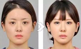 瘦脸针知识科普,科普瘦脸针知识