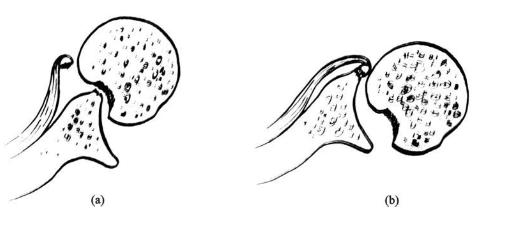 习惯性肩关节脱臼如何改善,肩关节脱位容易形成习惯性脱位吗