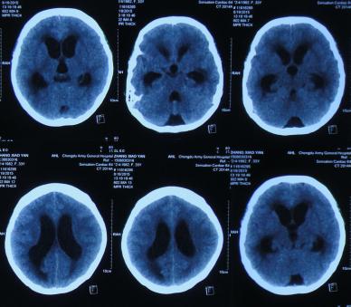 结核性脑积水,脑膜炎脑积水要治疗多久