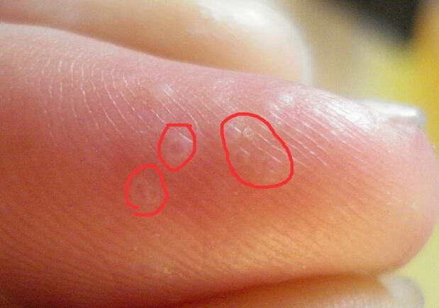 手上长汗疱疹去挠脚是不是会传染,汗疱疹手痒越挠越痒怎么缓解