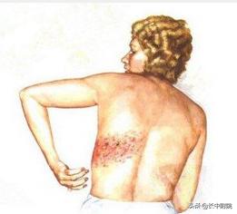 带状疱疹有趣科普标题,科普让带状疱疹不再可怕