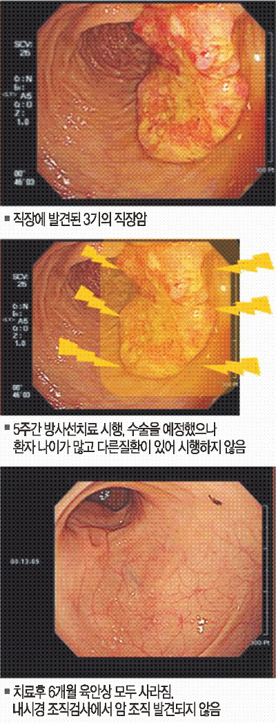 按压肿瘤会刺激肿瘤吗,放射线照射消除肿瘤