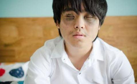 眼圈发黑是肾有什么问题,什么肾脏疾病导致黑眼圈