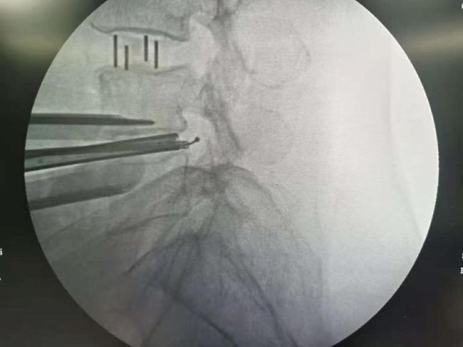 腰椎管狭窄有滑脱能做微创吗,腰椎滑脱椎管狭窄可做微创吗