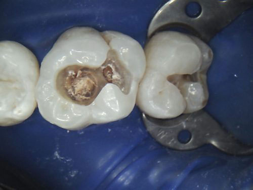 补牙有哪些流程,补牙以后需要注意什么