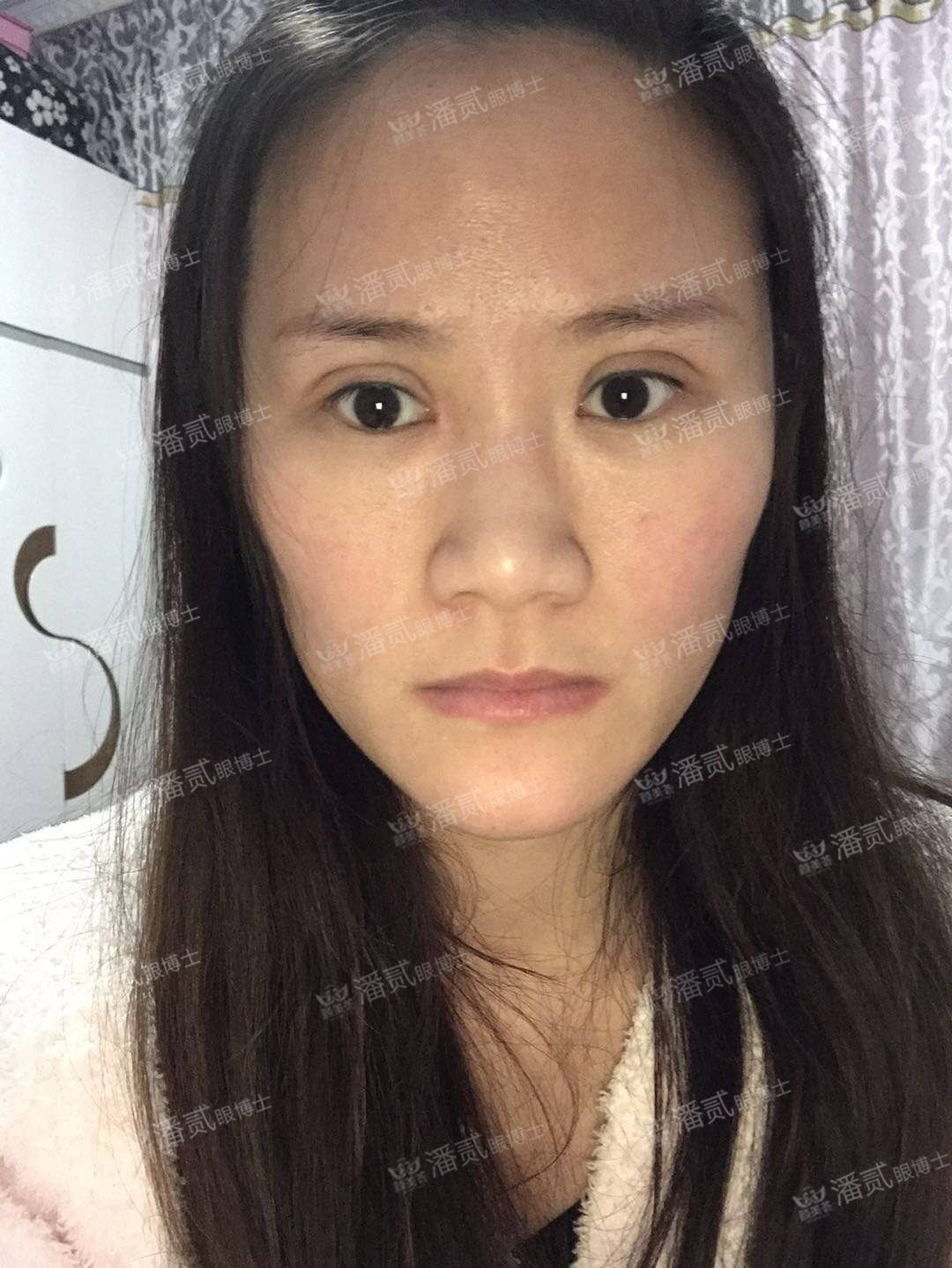 广州双眼皮凹陷修复视频,小切口双眼皮肉条修复