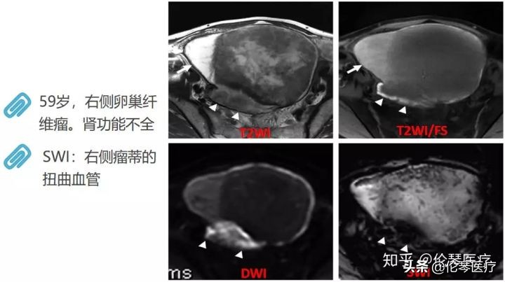 卵巢肿瘤核磁共振能看出来吗,超声测出来肿瘤