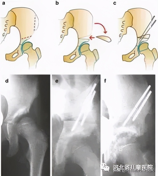 腿纹不对称家长千万别忽视,腿纹深浅不一样算不对称吗