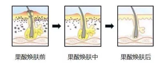 毛孔粗大肤质差如何去收缩毛孔,遮毛孔粗大收缩毛孔最有效的方法