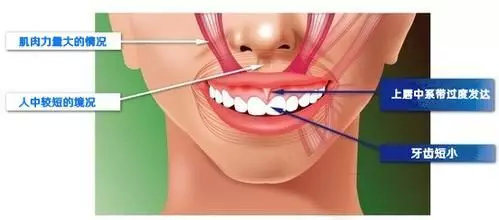 既有牙缝又有露龈笑先矫正哪个,儿童露龈笑最简单改善方法