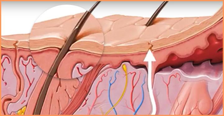 毛孔粗大问题应该如何正确解决,毛孔粗大怎么办教你一招根除