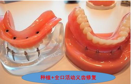 人到老年时，一望无牙，进食困难，怎么办？口腔医生给出3个方案