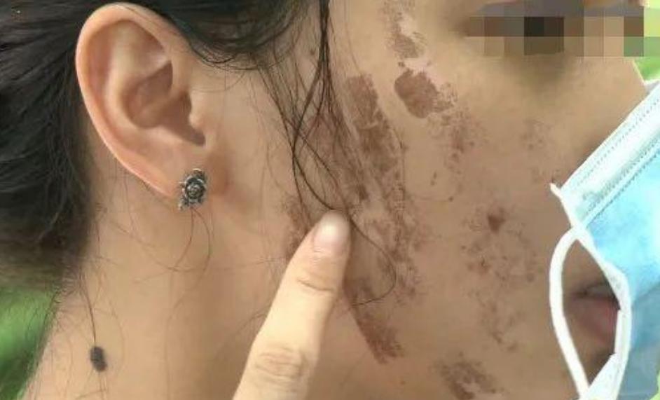 女子做完光子嫩肤后脸上全是黑疤,做完光子嫩肤后怎么黑了