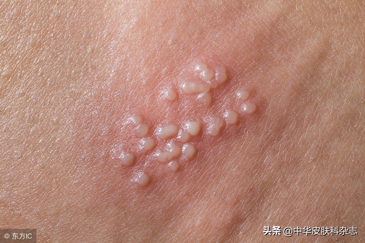 生殖器部位出现皮损就是性病吗？