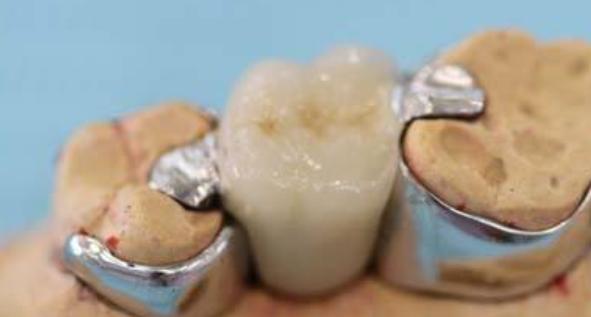 固定牙搭桥多少钱,固定桥修复牙齿价格