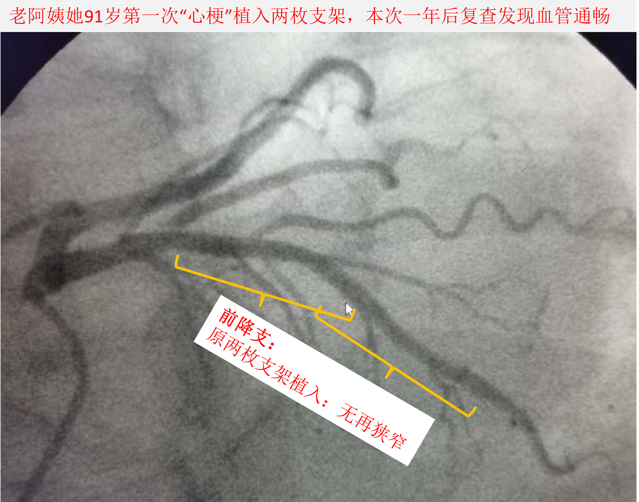 92岁心梗老人不能手术咋办,70岁冠心病植入支架以后还需住院