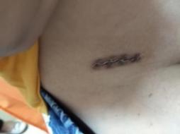 术后伤口要每天换药吗,术后伤口拆线还需要敷纱布吗