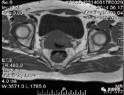 宫颈癌mri诊断,宫颈癌的mr扫描技术
